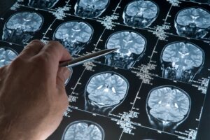 A scientist's hand pointing at an MRI brain scan of a head and skull